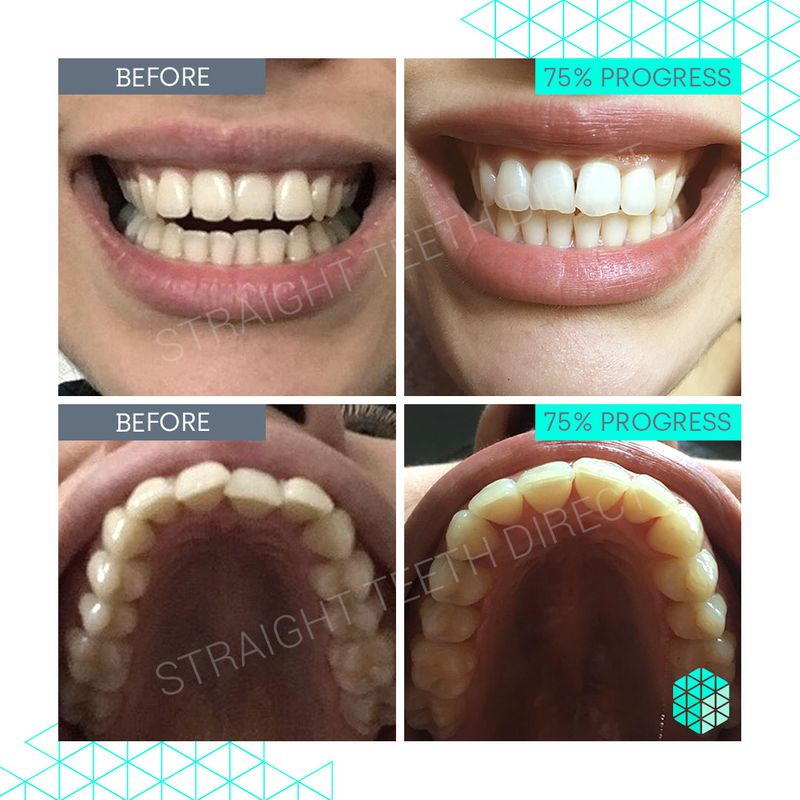 Straight Teeth Direct Review by Eugenia