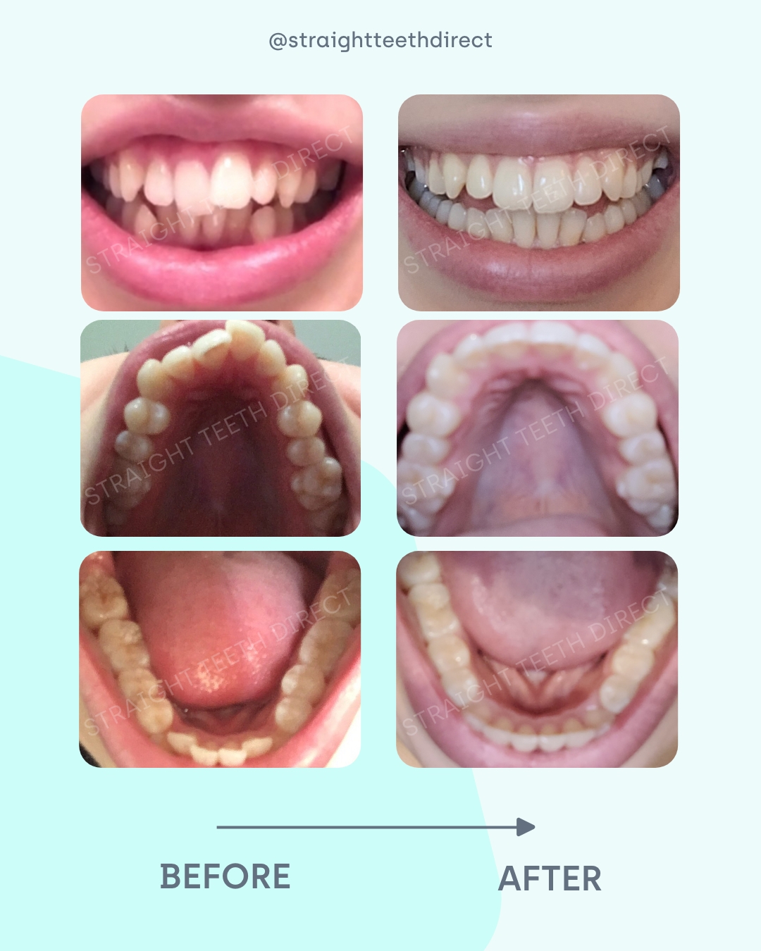 Helena before and after aligner transformation