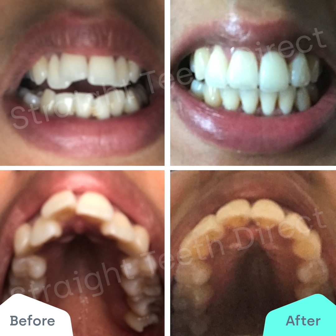 Straight Teeth Direct Review by Saraah Patel