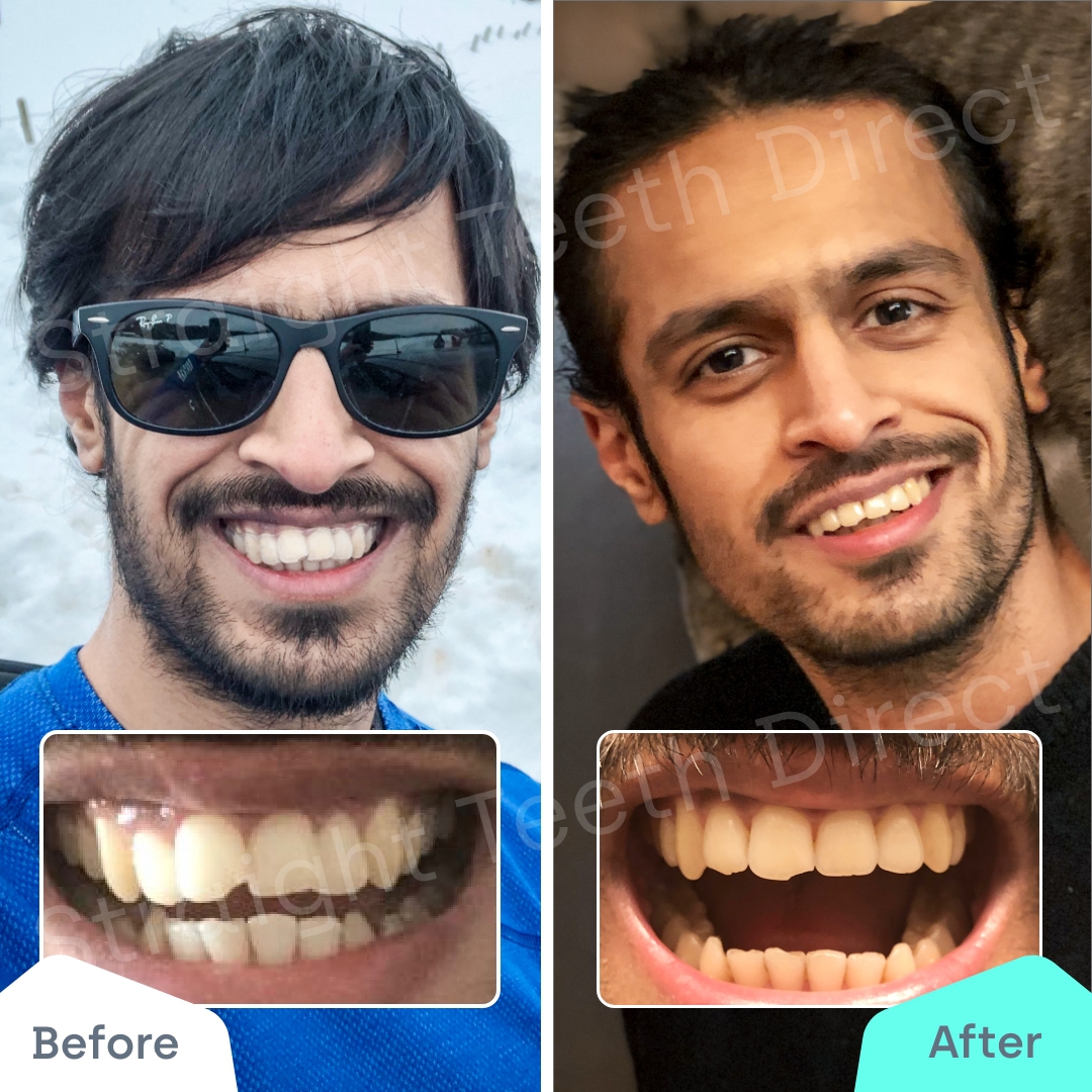 Straight Teeth Direct Review by Prash
