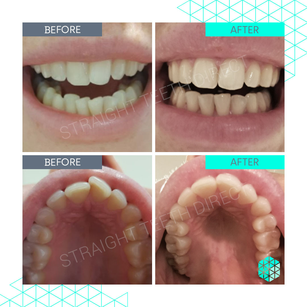 Straight Teeth Direct Review by Hannah