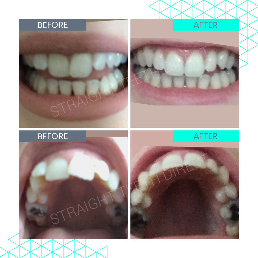 Straight Teeth Direct Review by Rae