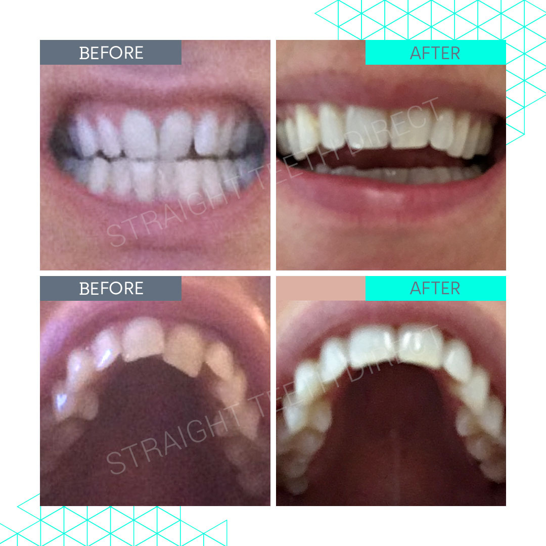 Straight Teeth Direct Review by Nat B