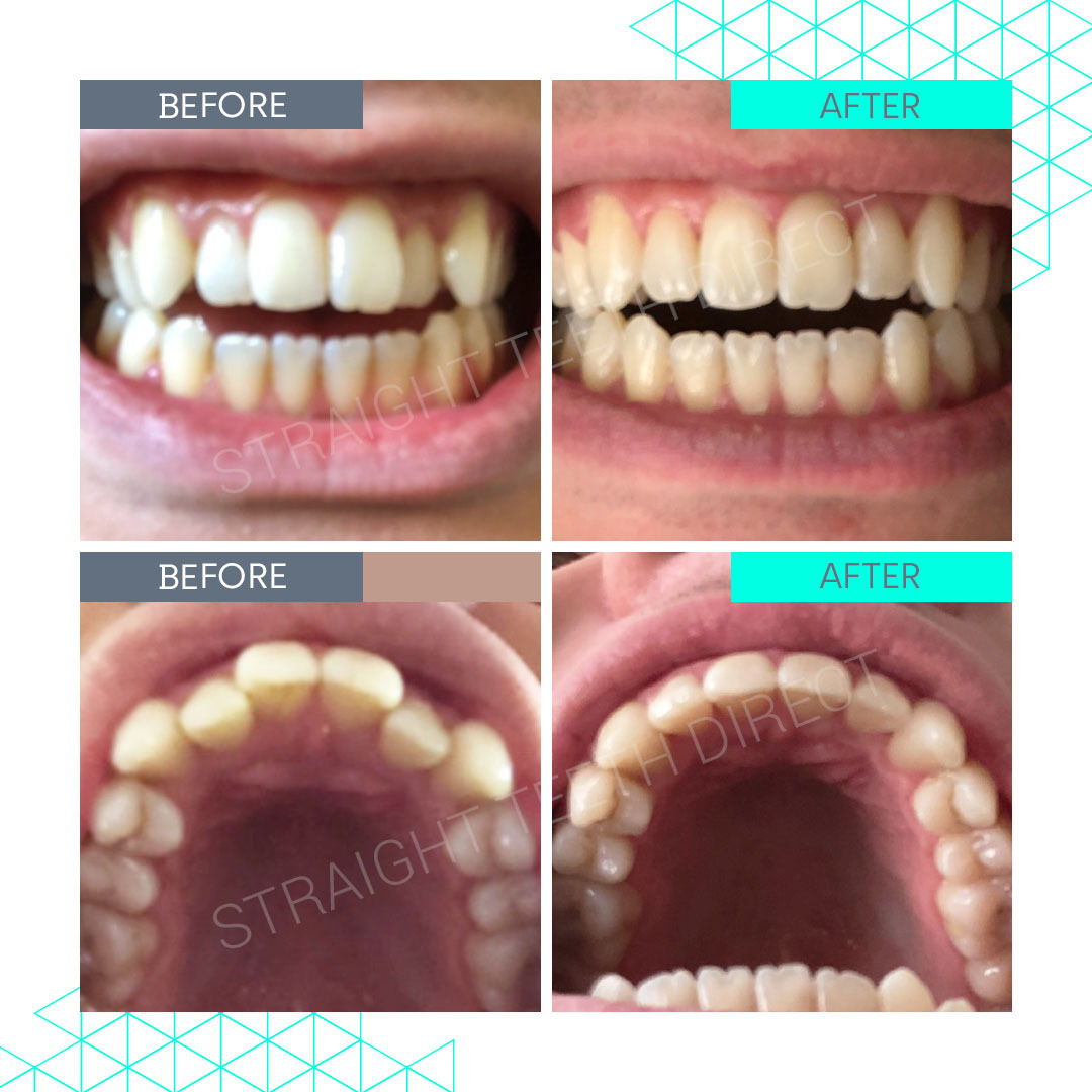 Straight Teeth Direct Review by Anonymous