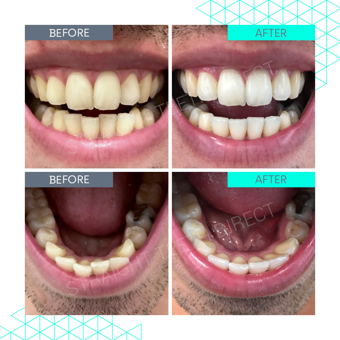 Straight Teeth Direct Review by Sam from Essex