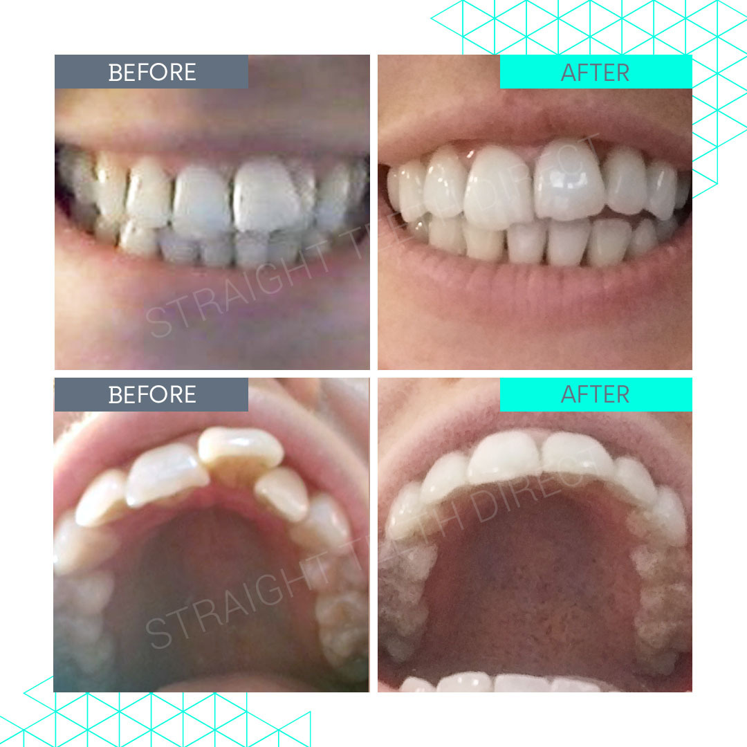 Straight Teeth Direct Review by Saskia