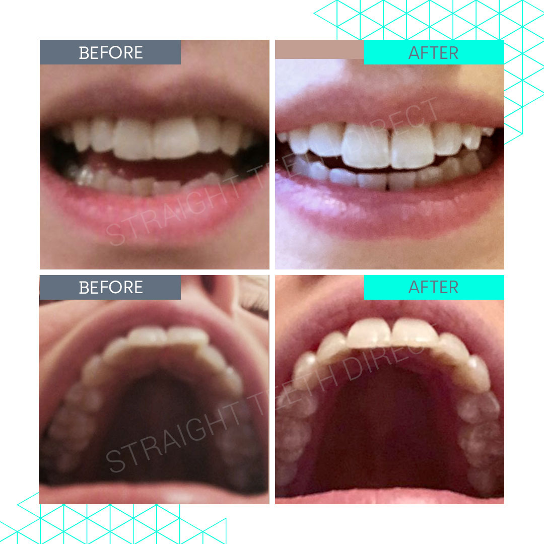 Straight Teeth Direct Review by Flo
