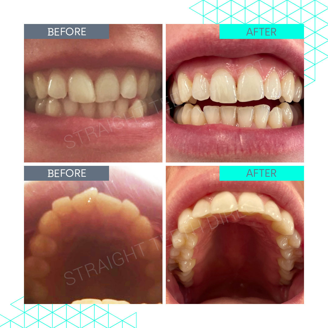 Straight Teeth Direct Review by Anonymous