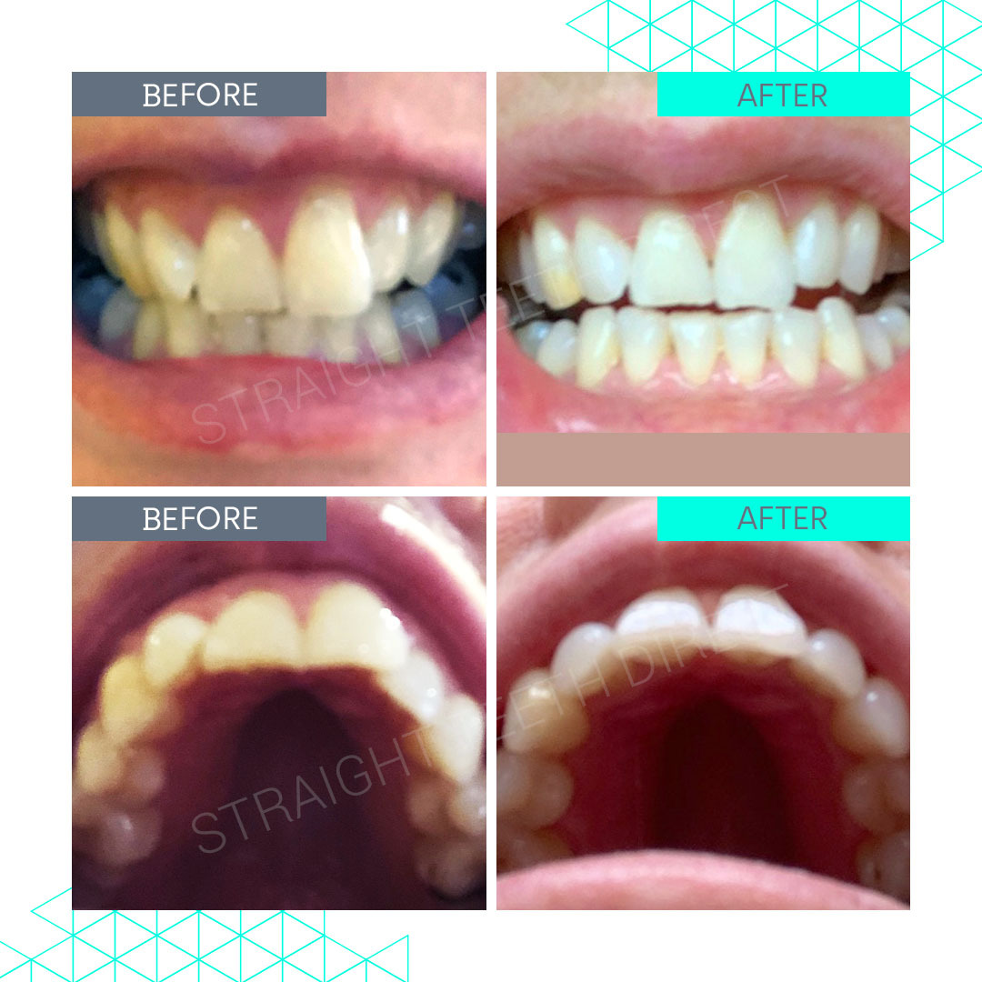 Straight Teeth Direct Review by Jane