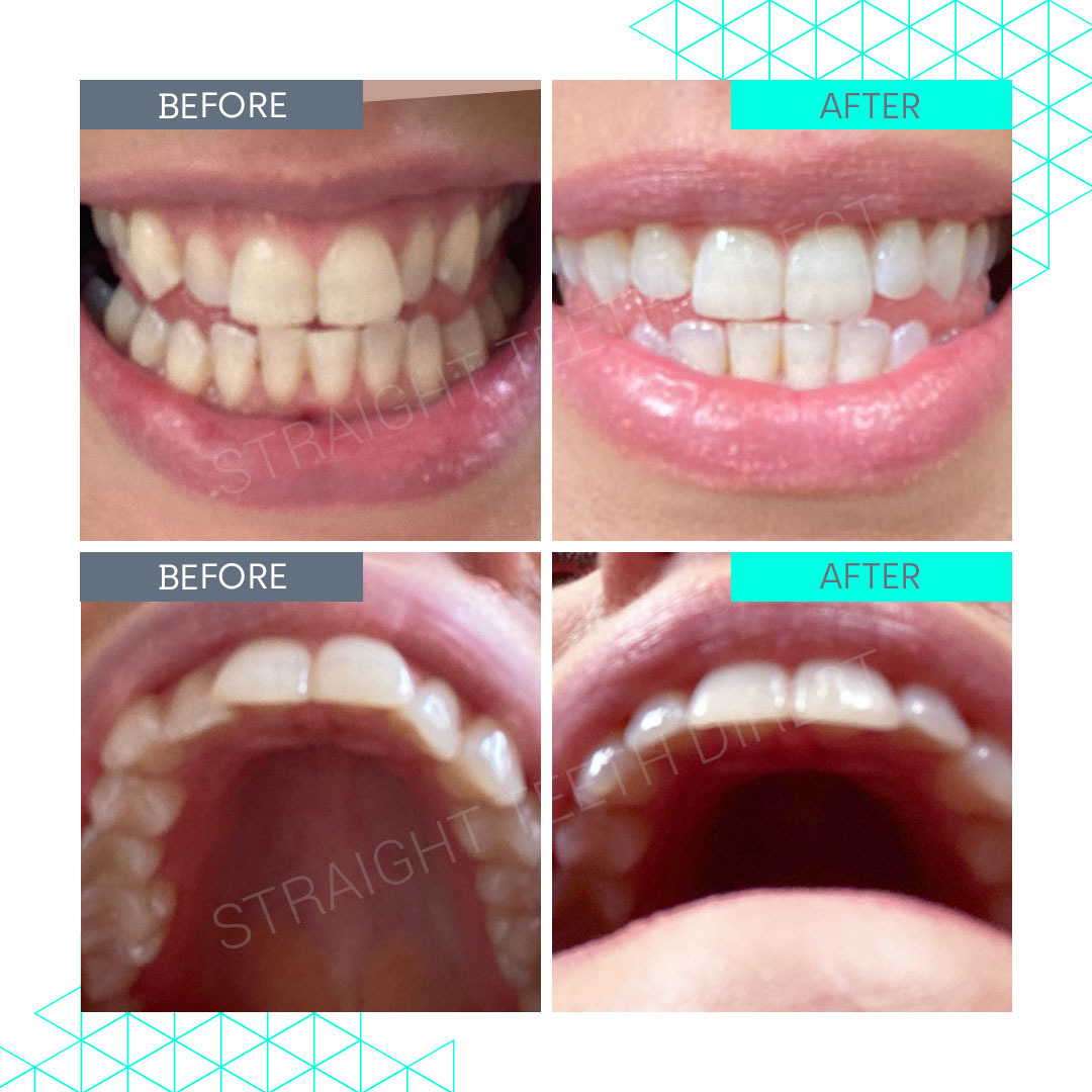Straight Teeth Direct Review by Danielle Odonnell