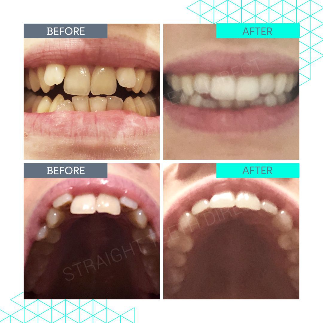 Straight Teeth Direct Review by Grace Upcraft