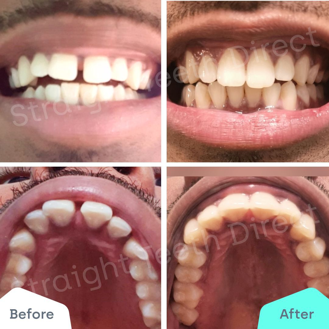 Straight Teeth Direct Review by Jay Jayasinghe