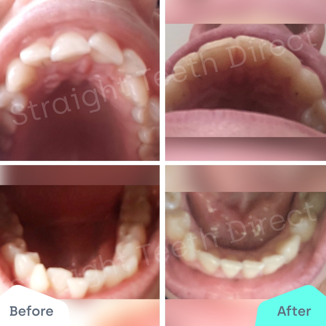 Straight Teeth Direct Review by Magi
