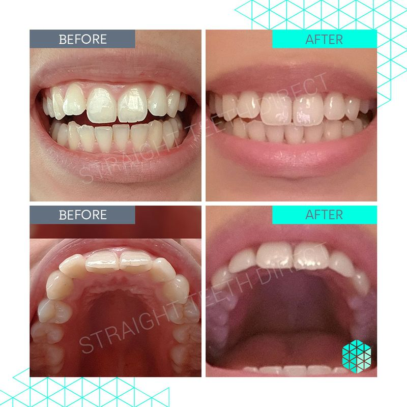 Straight Teeth Direct Review by Geraldine