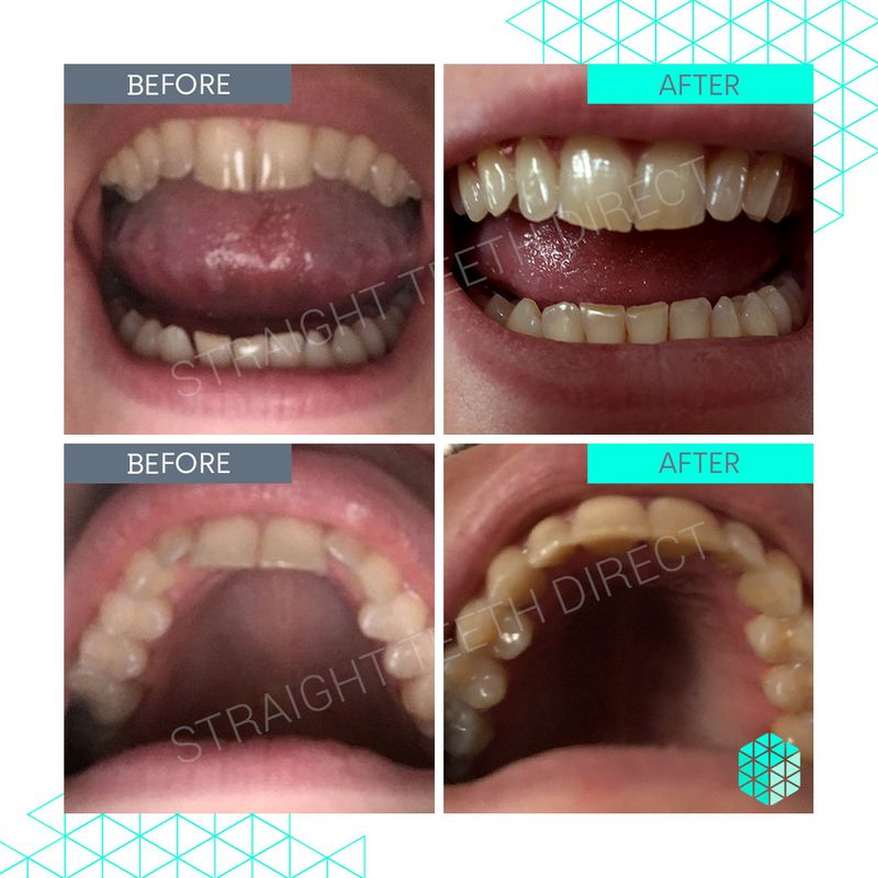 Straight Teeth Direct Review by Leah