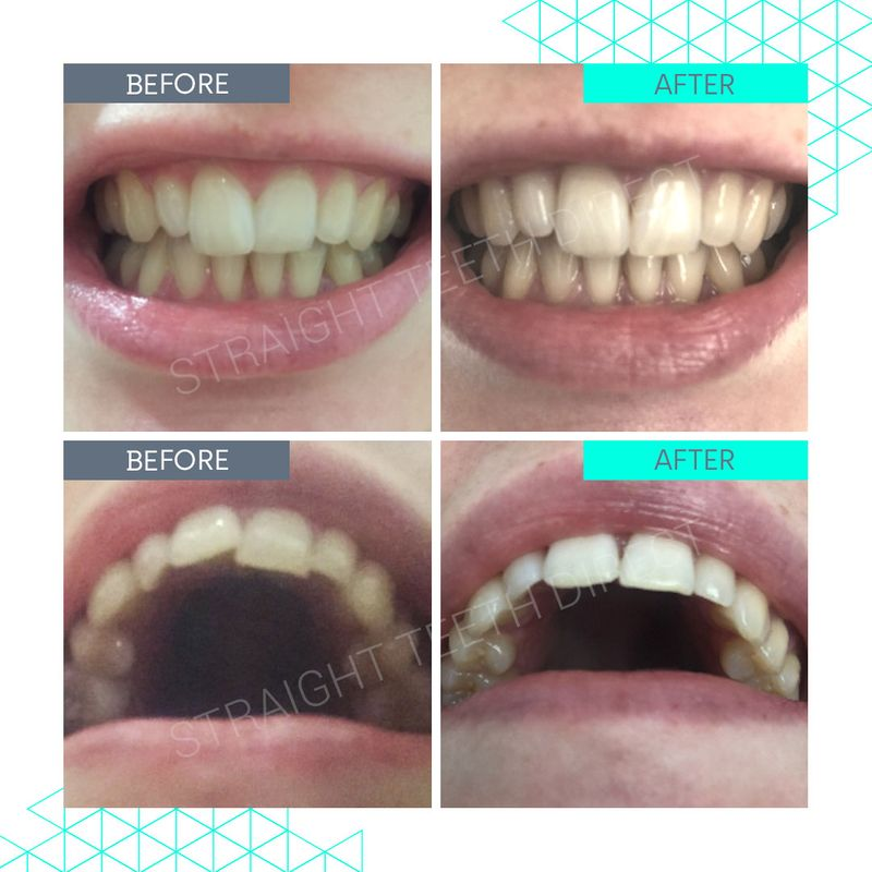 Straight Teeth Direct Review by Gigi