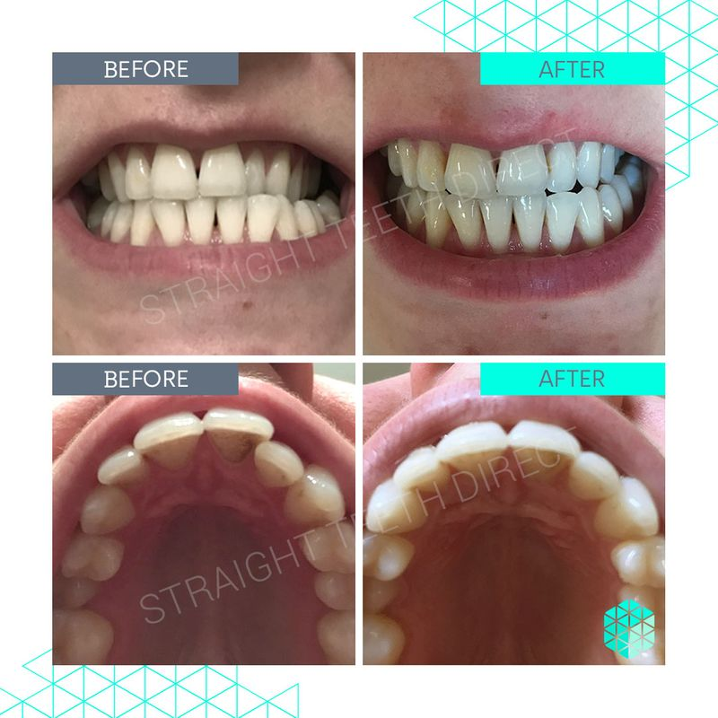 Straight Teeth Direct Review by Emily