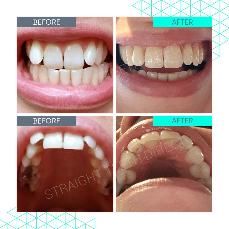Straight Teeth Direct Review by Lizzie