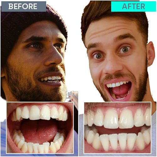 Straight Teeth Direct Review by Joe
