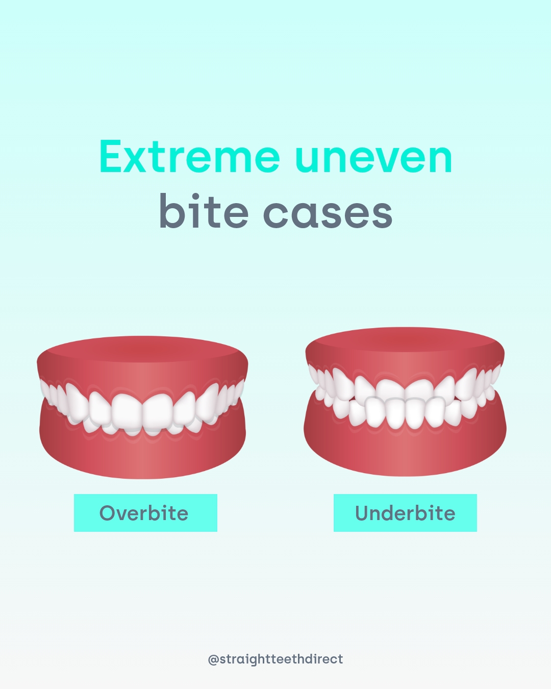 Overbite and underbite