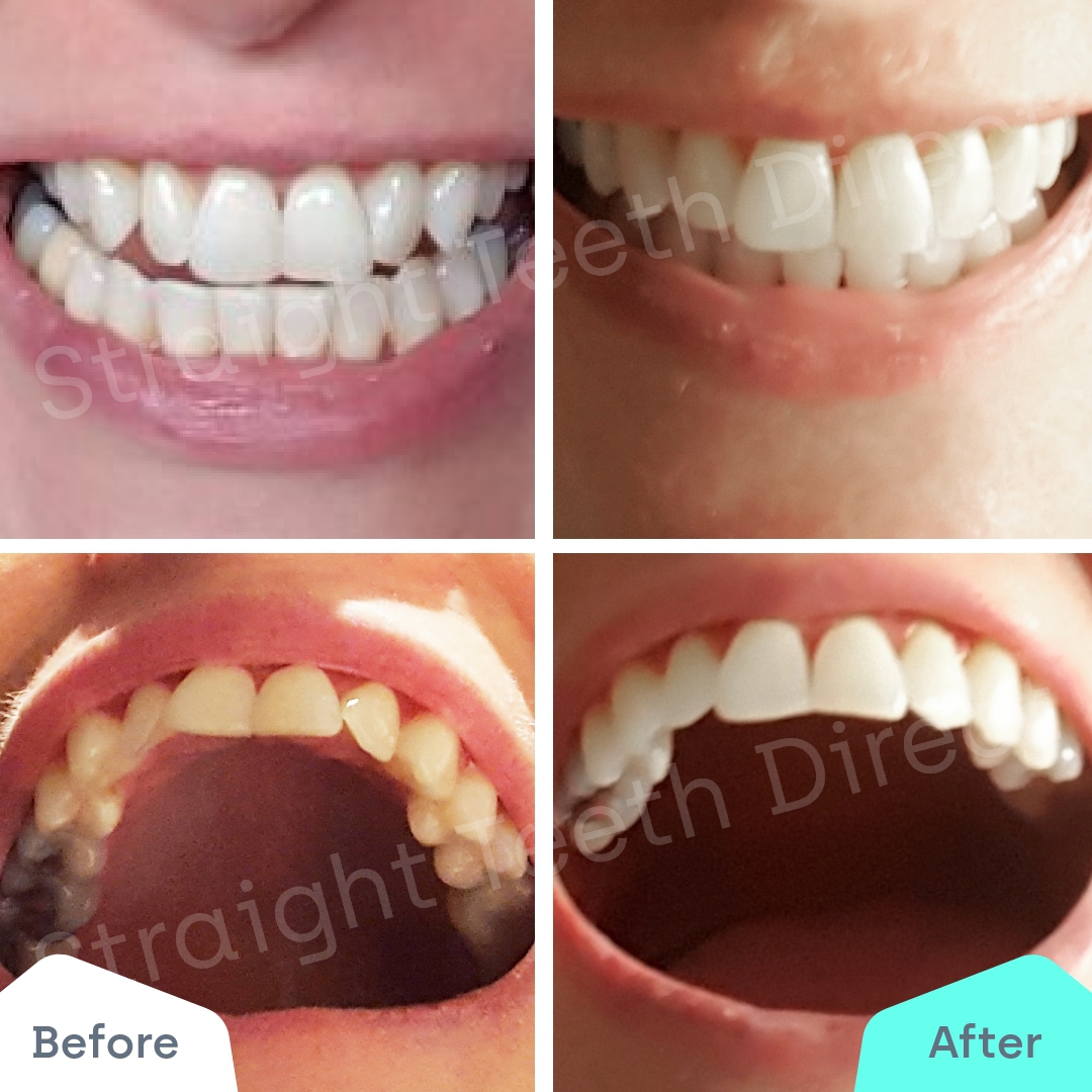 Straight Teeth Direct Review by Vicky Lou