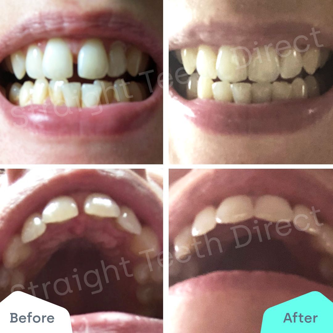 Straight Teeth Direct Review by Lisa