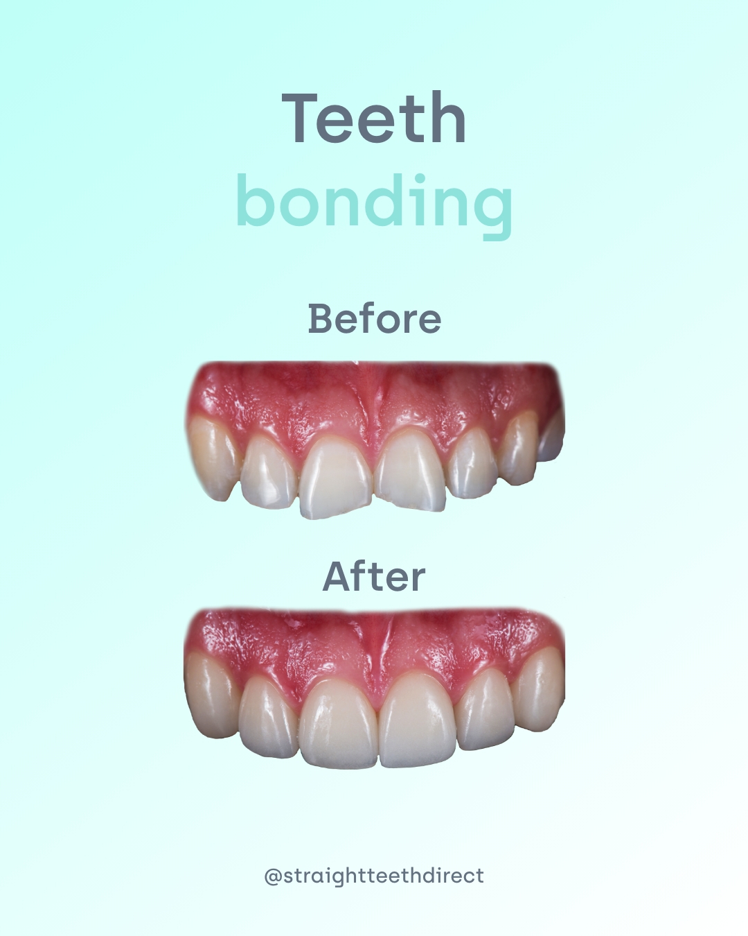 Before and after teeth bonding