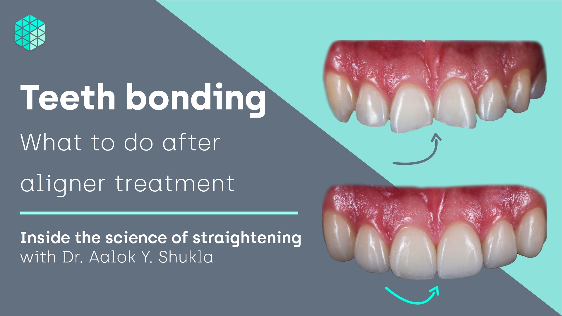 Teeth bonding - After aligner treatment