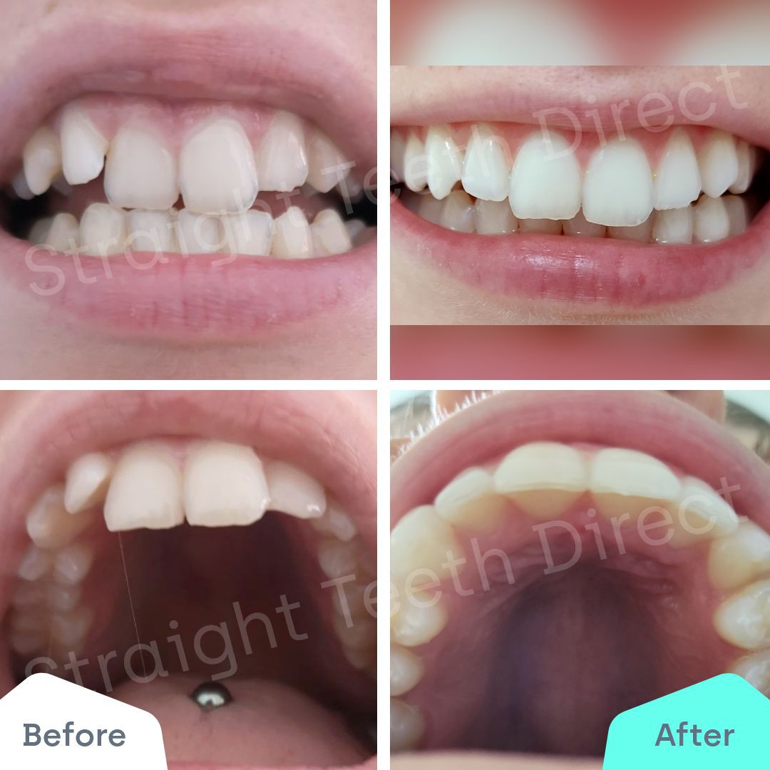 Straight Teeth Direct Review by Sianm
