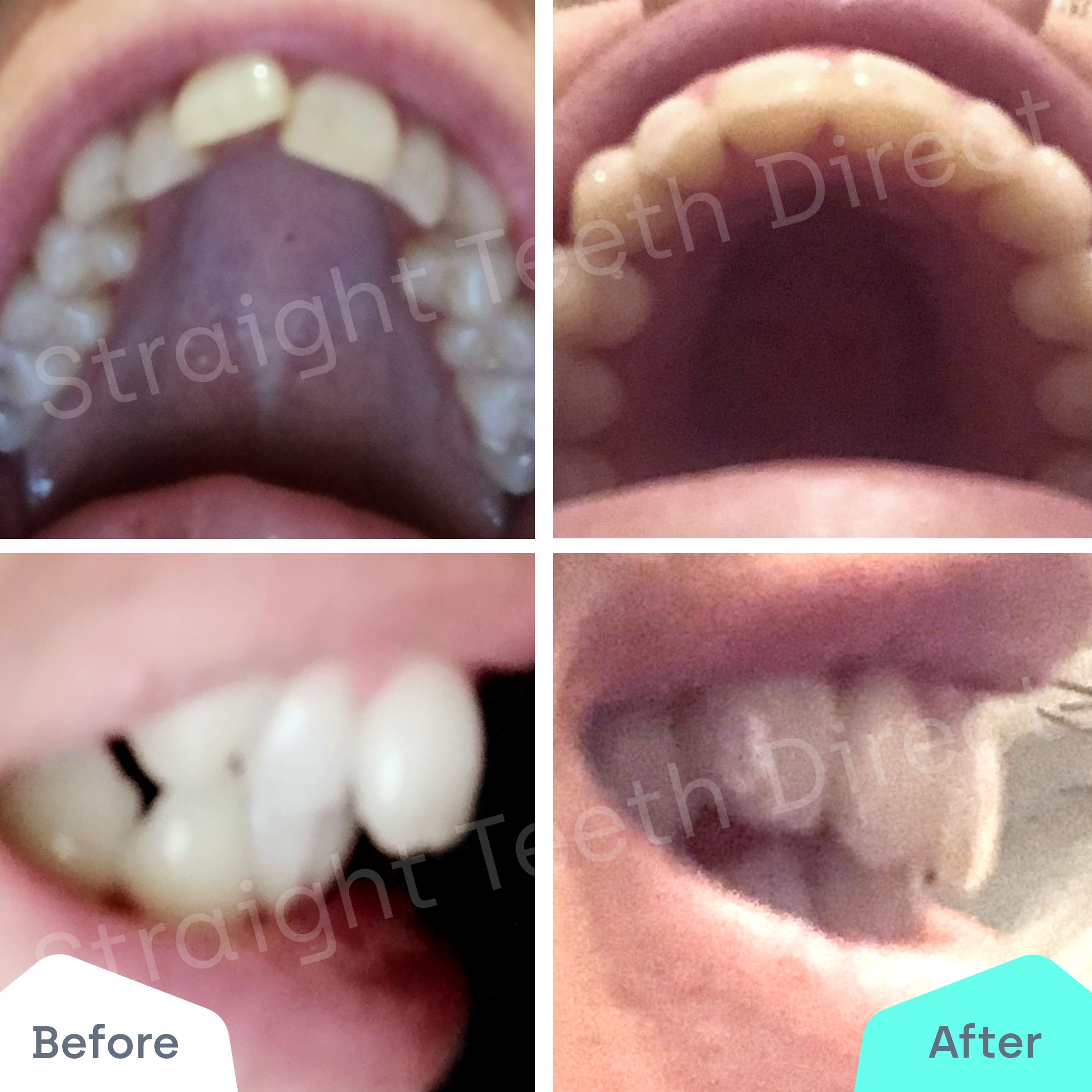 Straight Teeth Direct Review by Anonymous