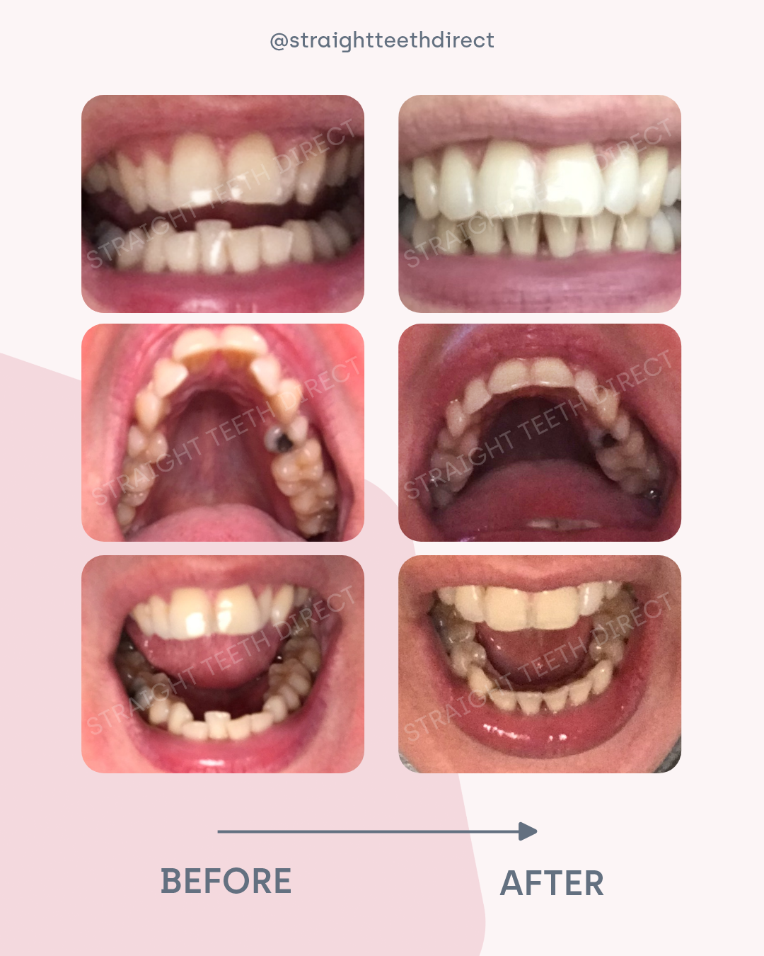 Michelle clear aligners before and after pictures