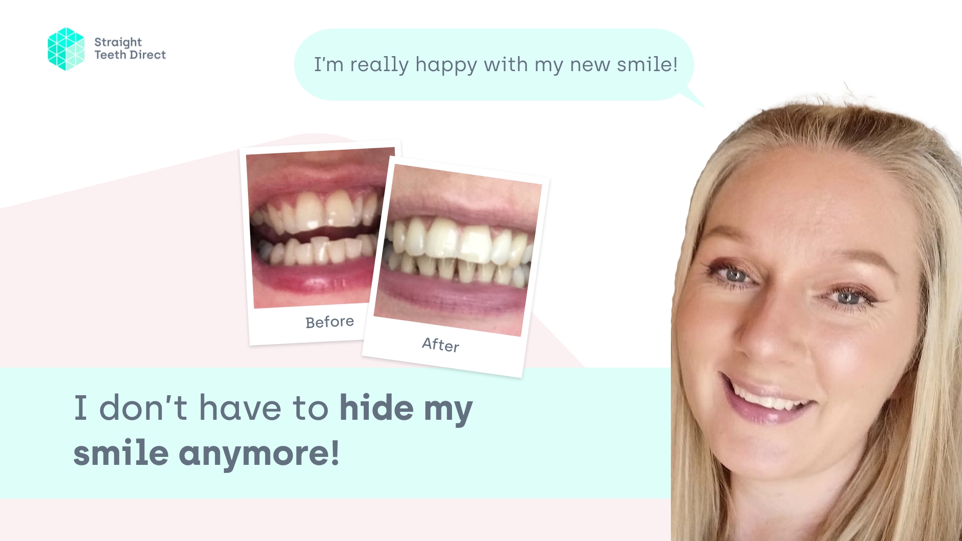 Michelle Guest blog clear aligners transformation