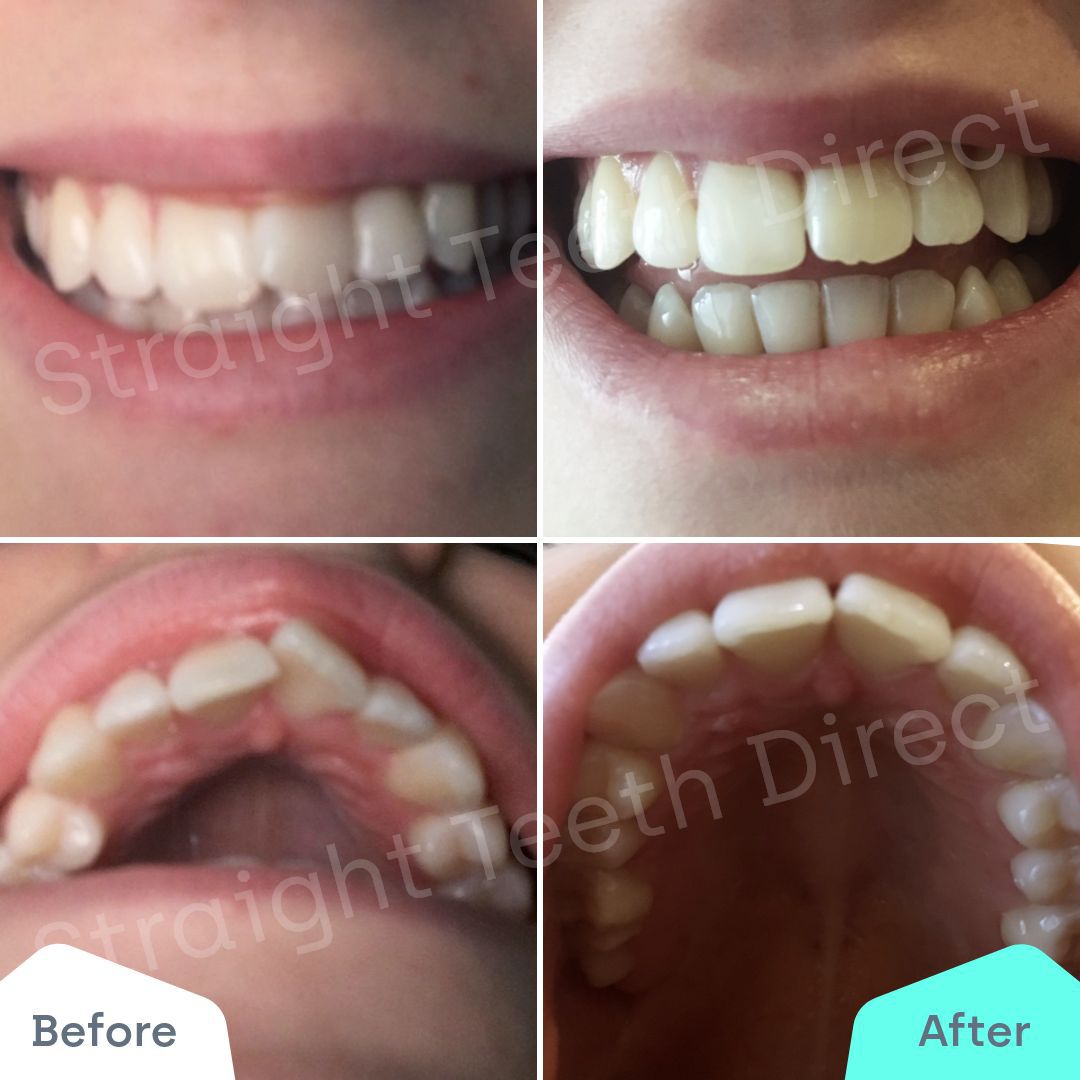Straight Teeth Direct Review by Megan