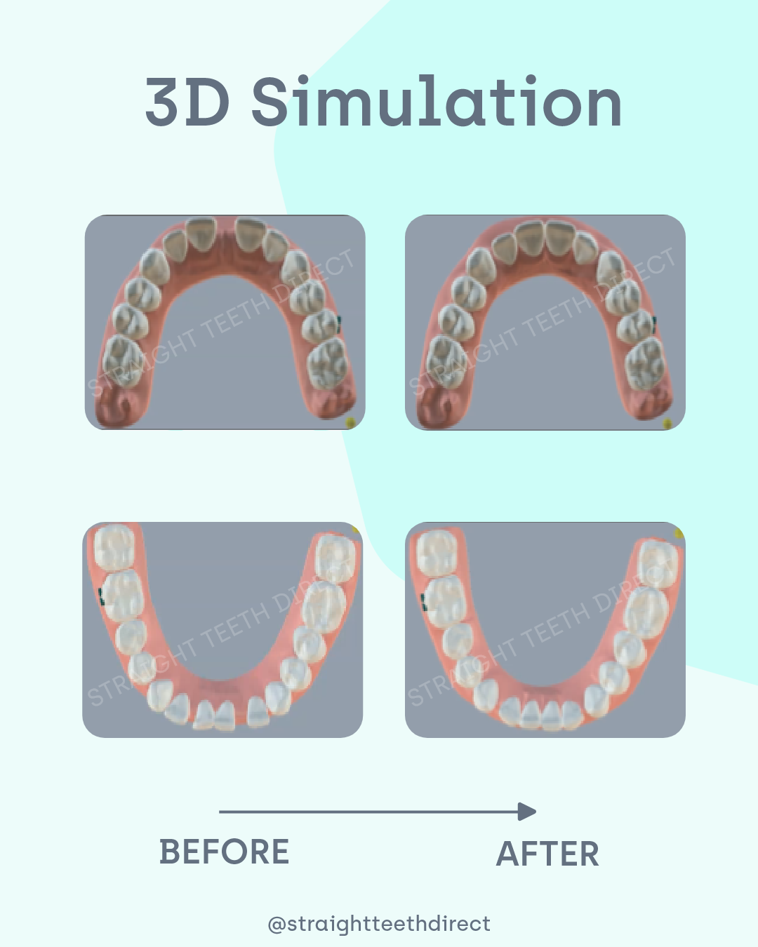 3D smile simulation with aligners