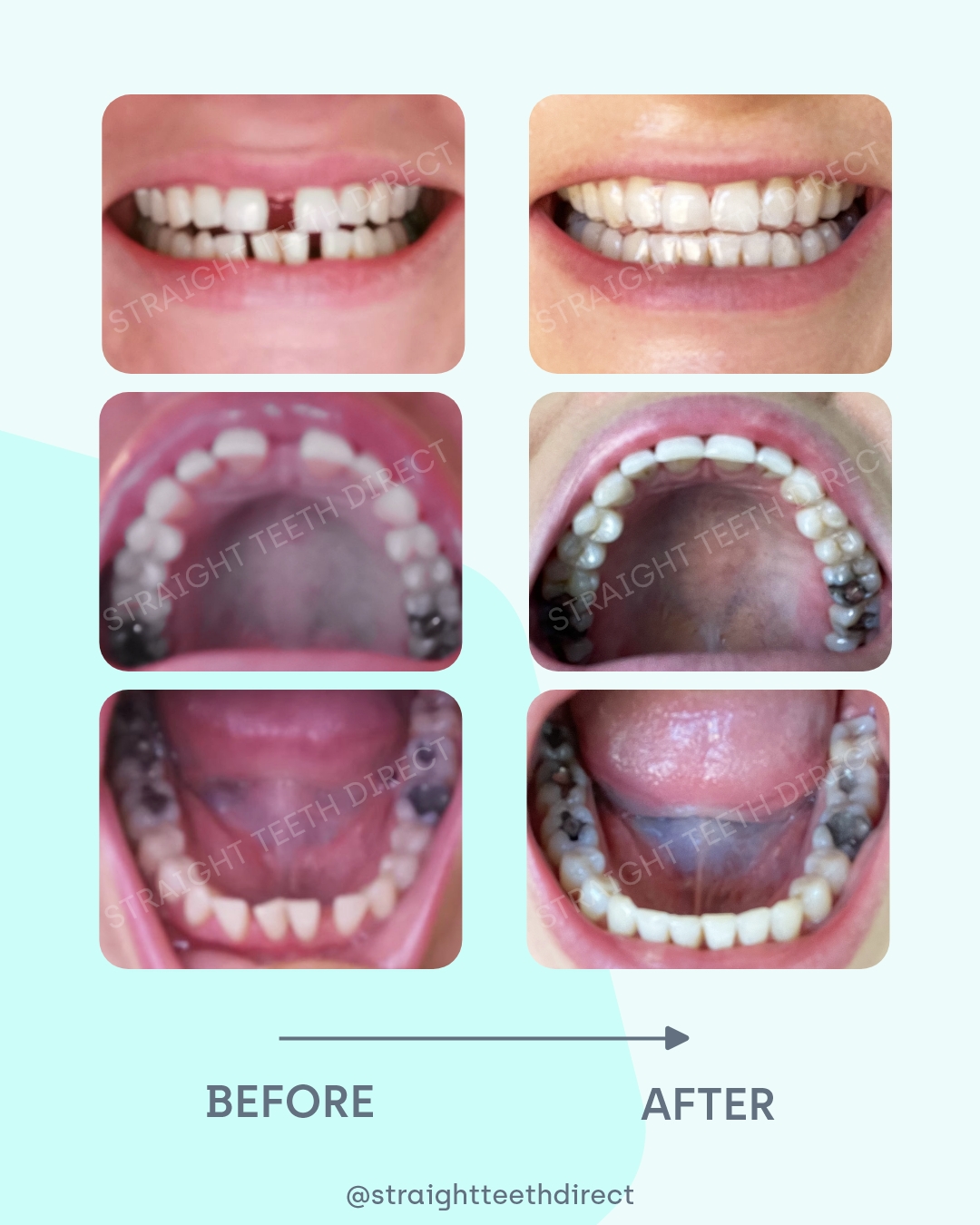 Emma clear aligners before and after transformation