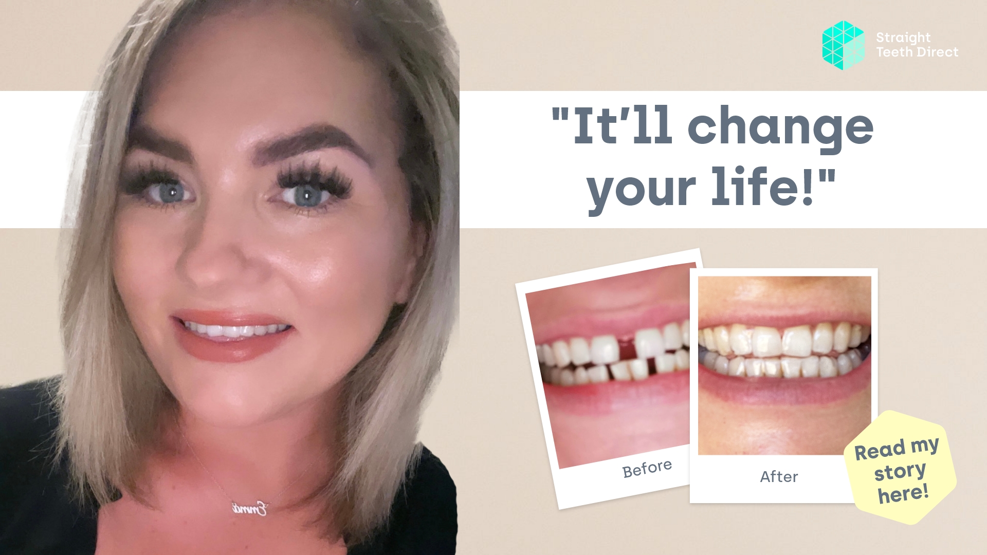 Emma Clear aligners guest post that will change your life