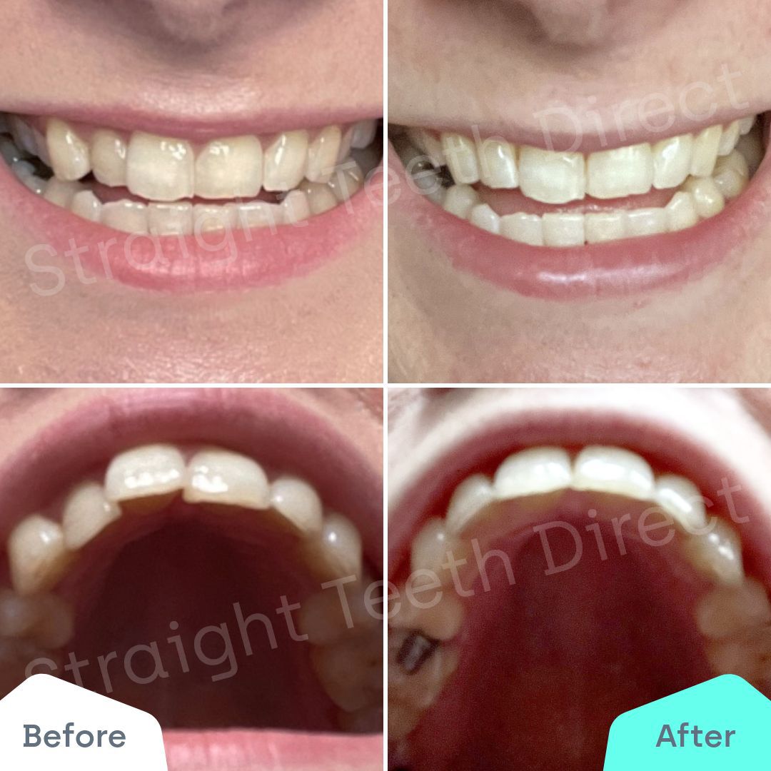 Straight Teeth Direct Review by Saf