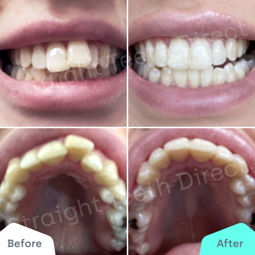Straight Teeth Direct Review by Holly