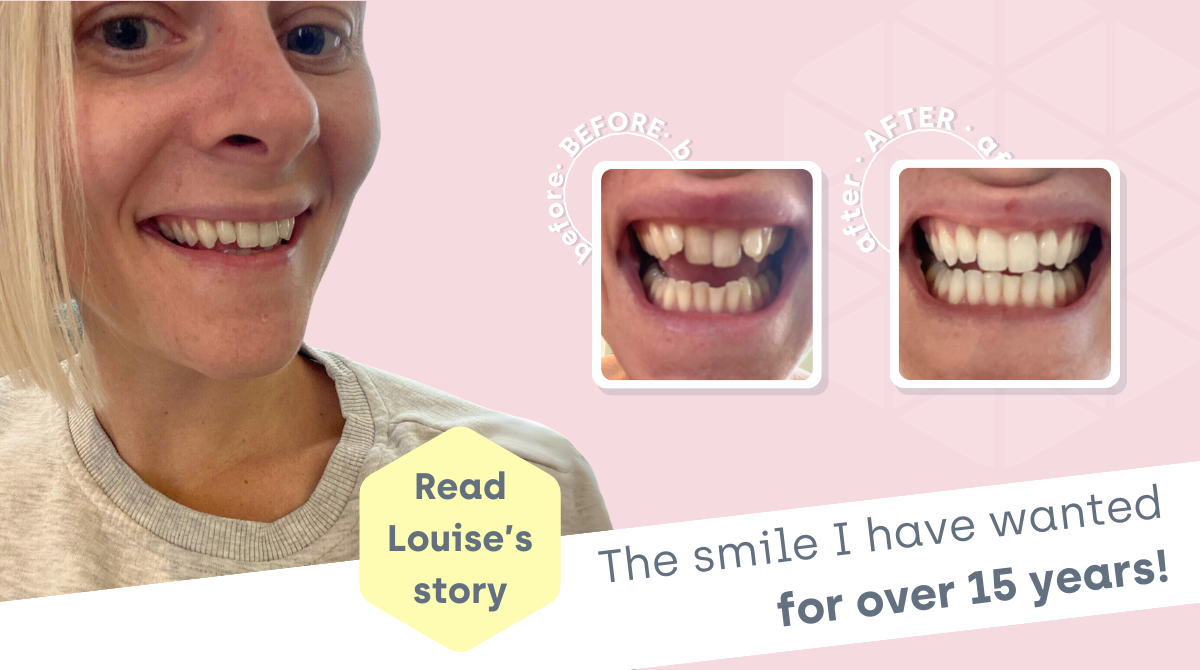 Louise aligners for teeth